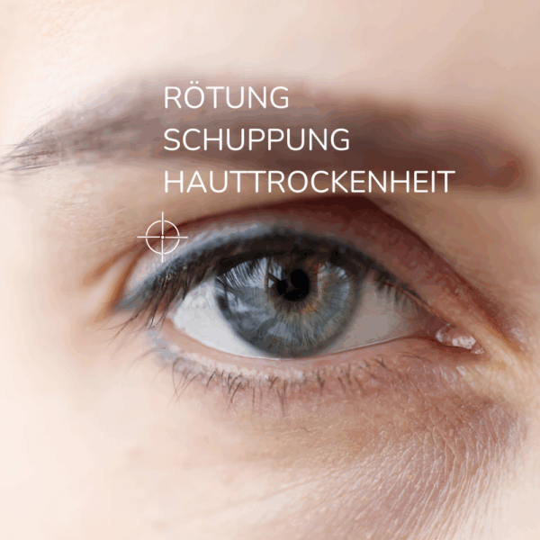 Zeigt ein Auge mit den typischen Symptomen bei einem Augenlidekzem